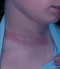 Oblong rash associated with Lyme.